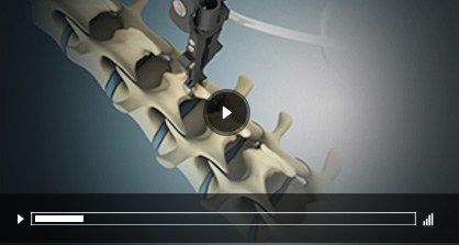Patient Education Videos of Ryan Stuckey, MD - Board Certified Orthopedic Surgeon - Spine Specialist